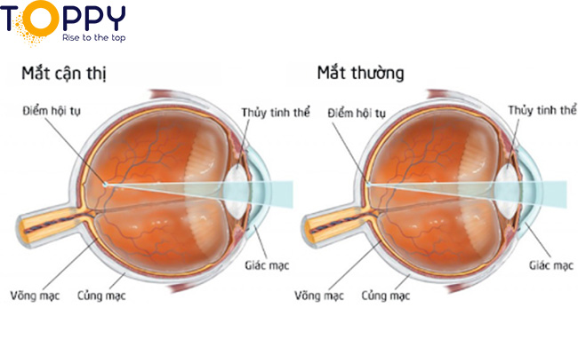 Các loại mắt nào có đặc điểm fmax OV